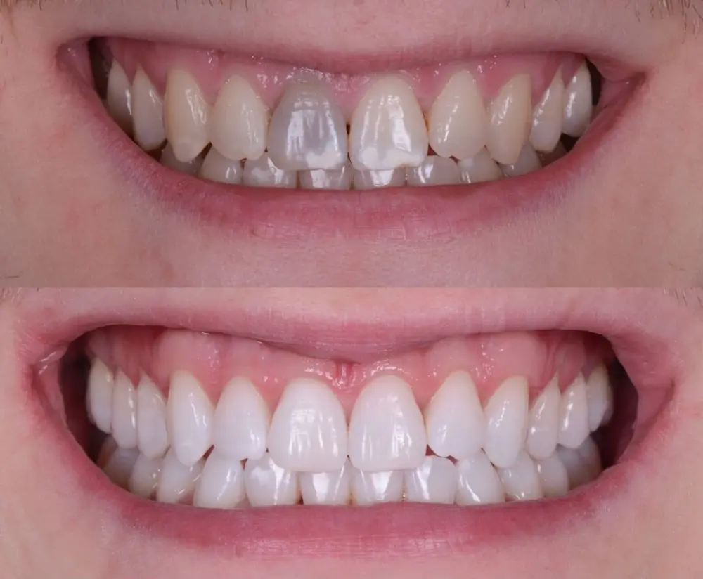 Enlighten whitening before after