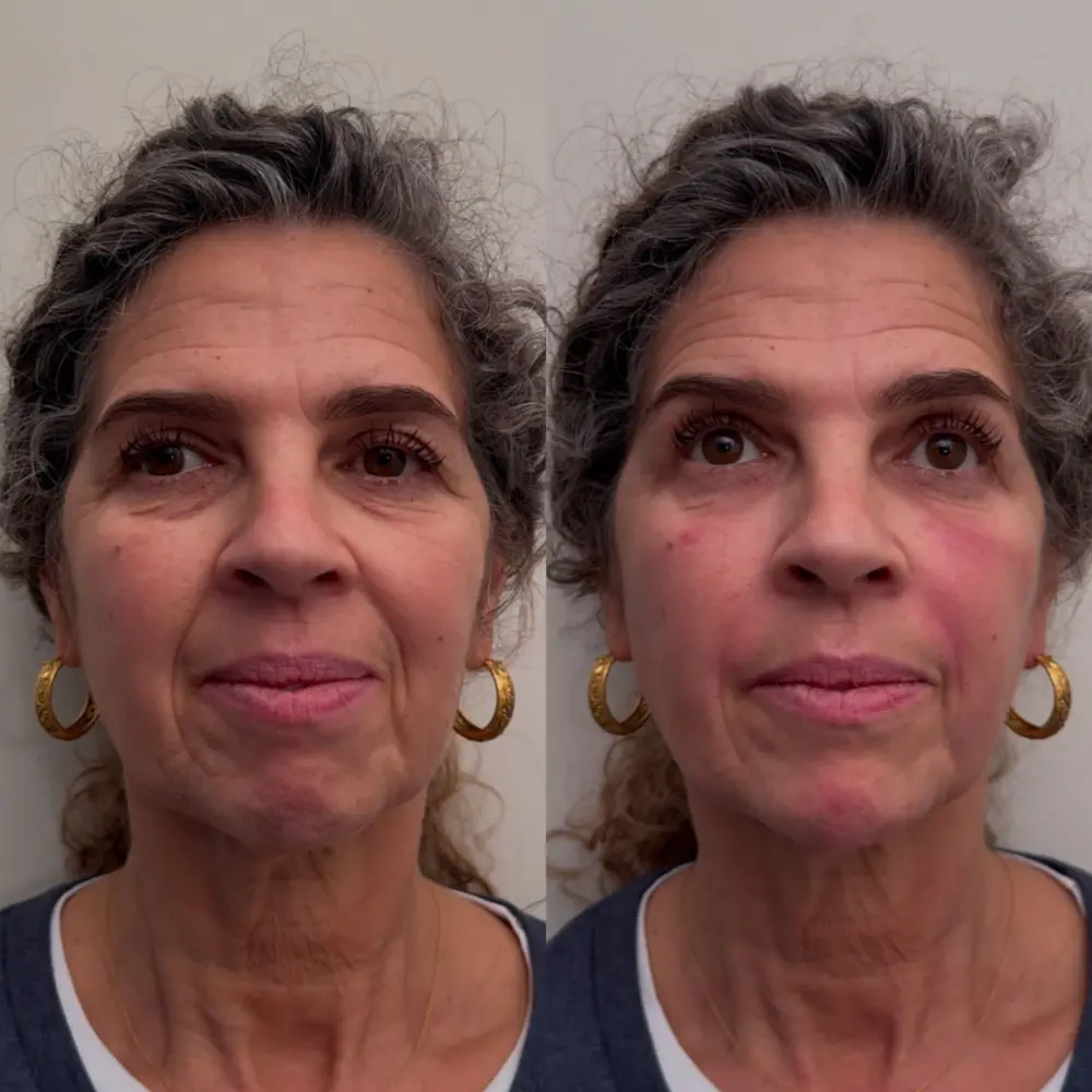 Prp face before after