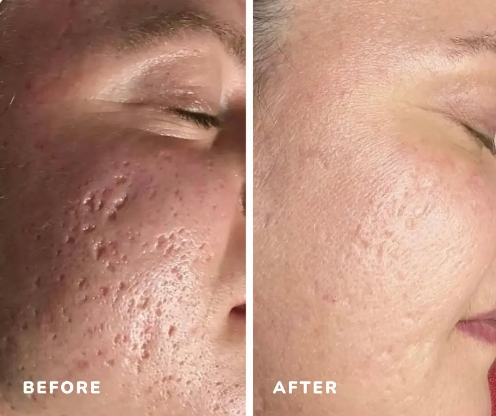 Imedpen before after