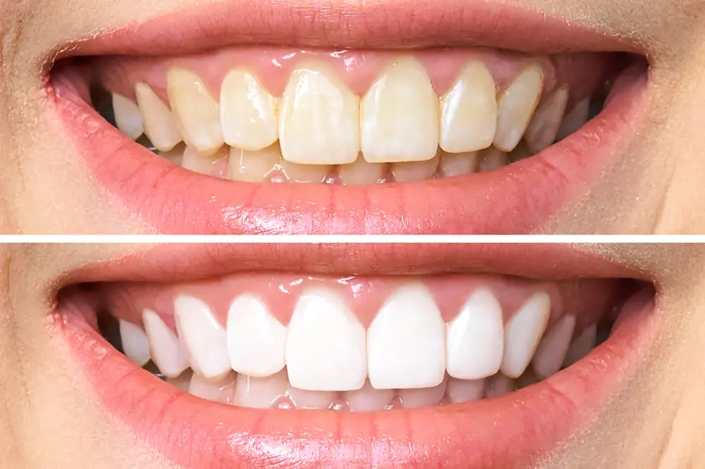Whitening before after
