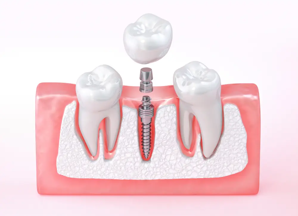 A dental implant procedure showing a screw-like implant anchored in the gum with a crown being placed on top of the implant between two natural teeth.