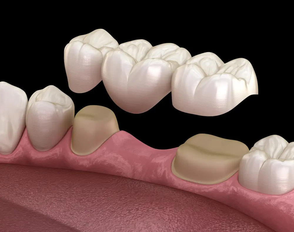 Close-up of a dental model showing upper and lower teeth with some teeth missing, highlighting dental anatomy and oral health.