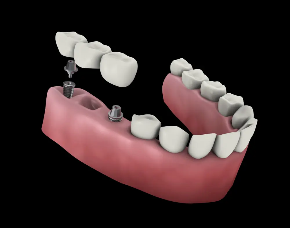 Dental implant procedure with artificial teeth and implant posts on a pink gum model, showing the step-by-step process of tooth restoration.