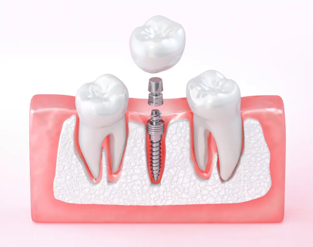 Dental implant procedure showing a screw in the jawbone, with two molars and an abutment ready for the crown placement over the implant.