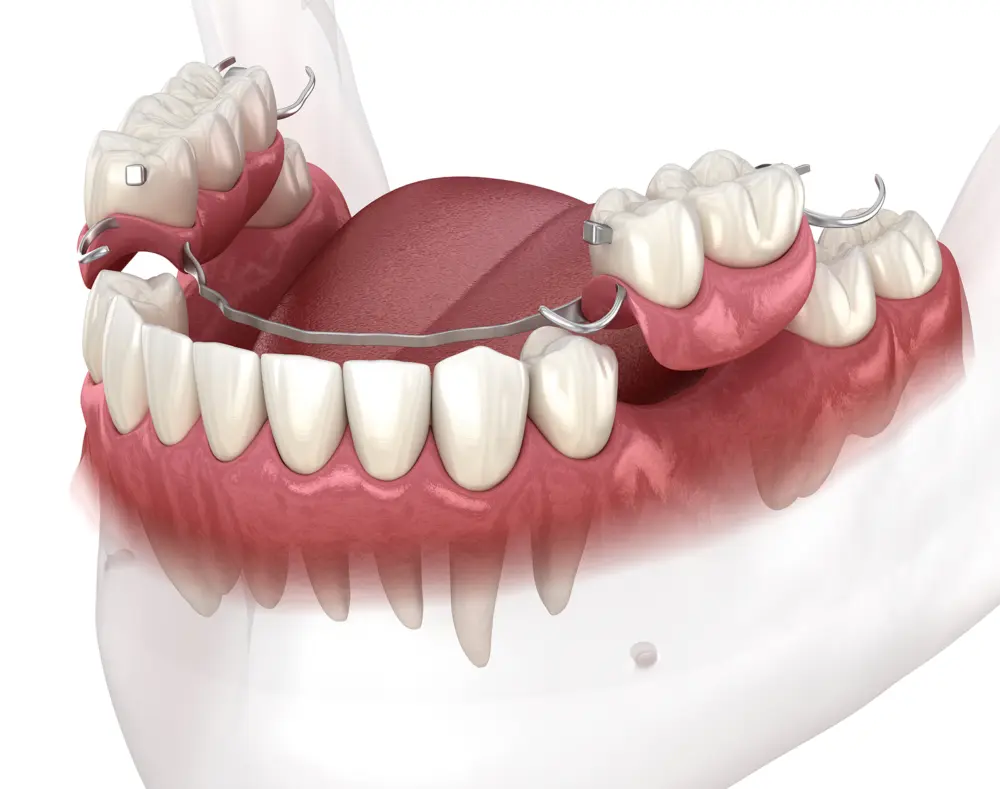 Lower jaw with teeth, gums, and a metal dental appliance or retainer fitted across the teeth in the mouth.