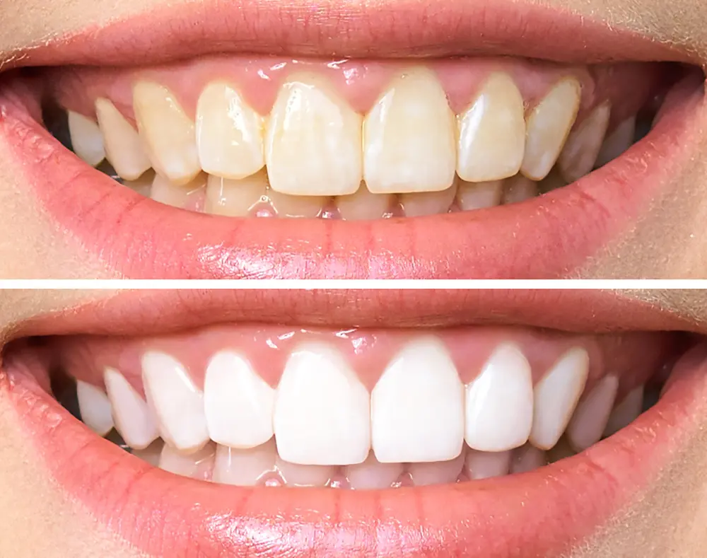 What Causes Discoloured Teeth?