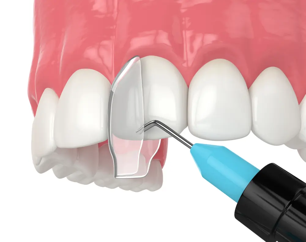A dental model showing a tooth being cleaned with a dental mirror and a blue-tipped dental tool, set against a background of pink gums and white teeth.