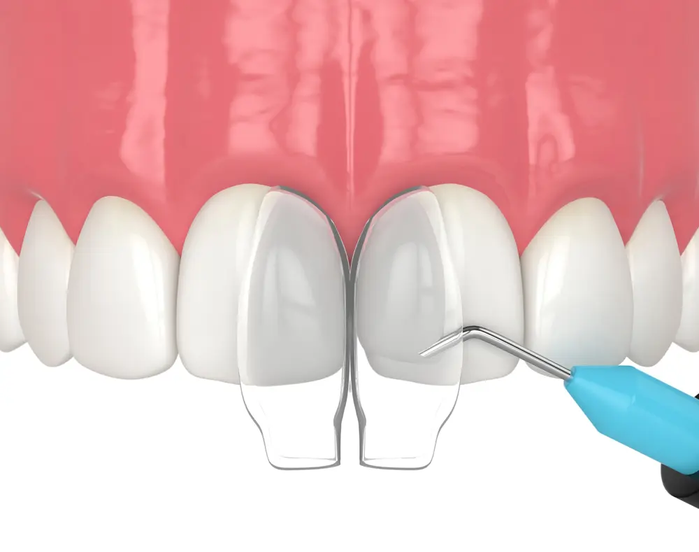 Close-up of a dental procedure with a dental mirror and tool near front teeth and gum. The image features a realistic depiction of teeth and pink gums.