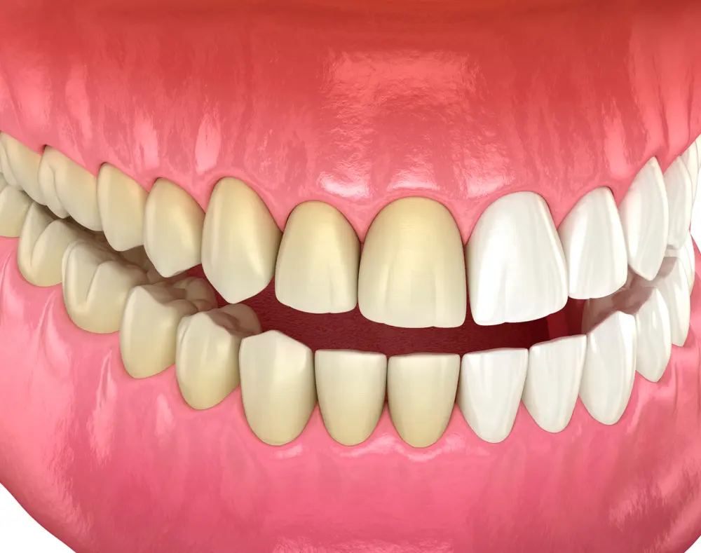 Can Yellow Teeth Become White Again?