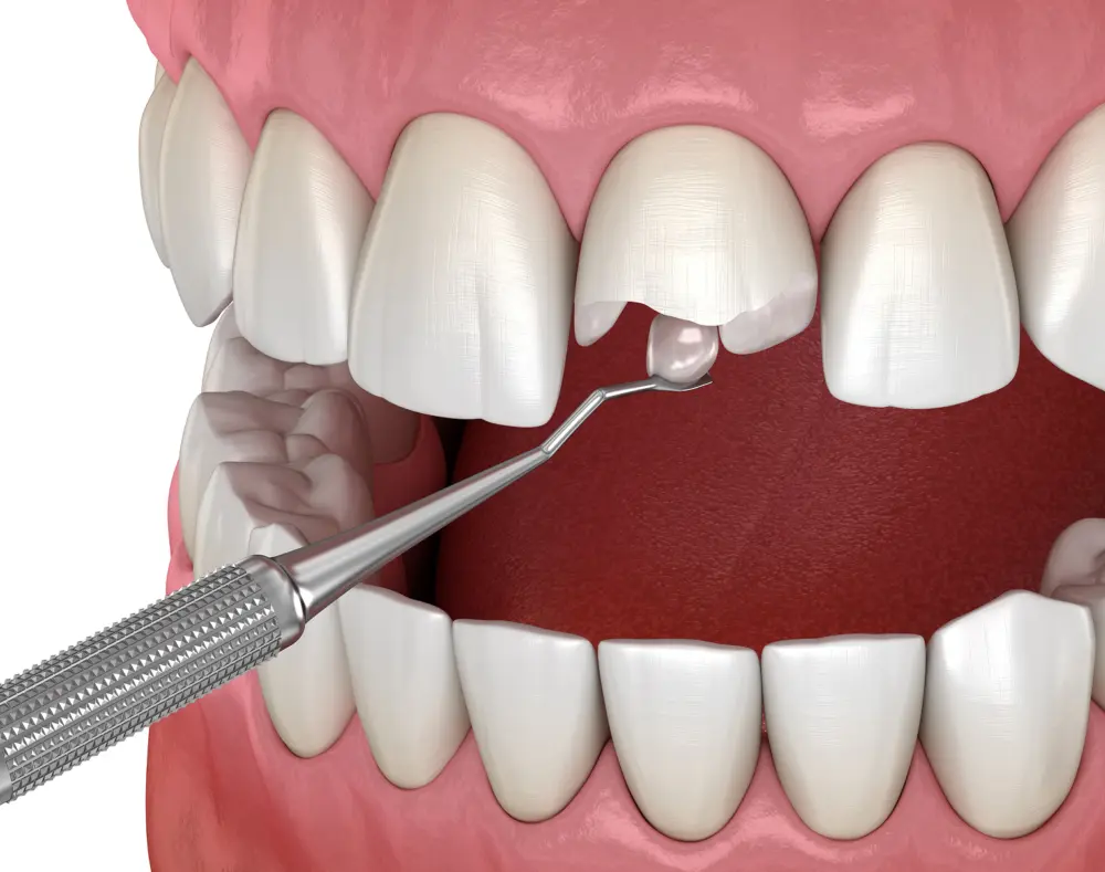 Treatment Options for Broken Teeth