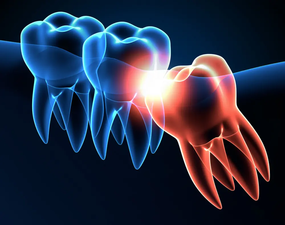 A digital illustration of human molar teeth, with the first molars glowing blue and the wisdom tooth glowing red, highlighting dental anatomy.