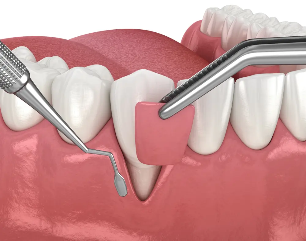 Dental procedures involving removal of plaque and tartar from teeth with dental tools and interdental brush in a detailed close-up illustration.