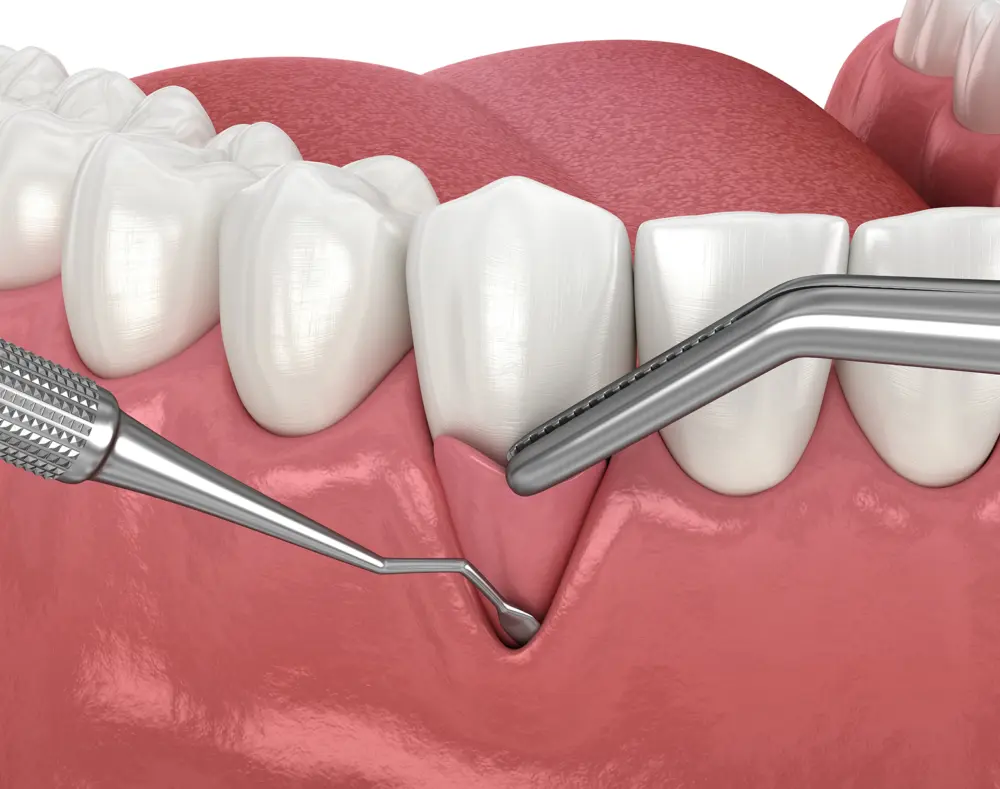 How to Stop Receding Gums From Getting Worse