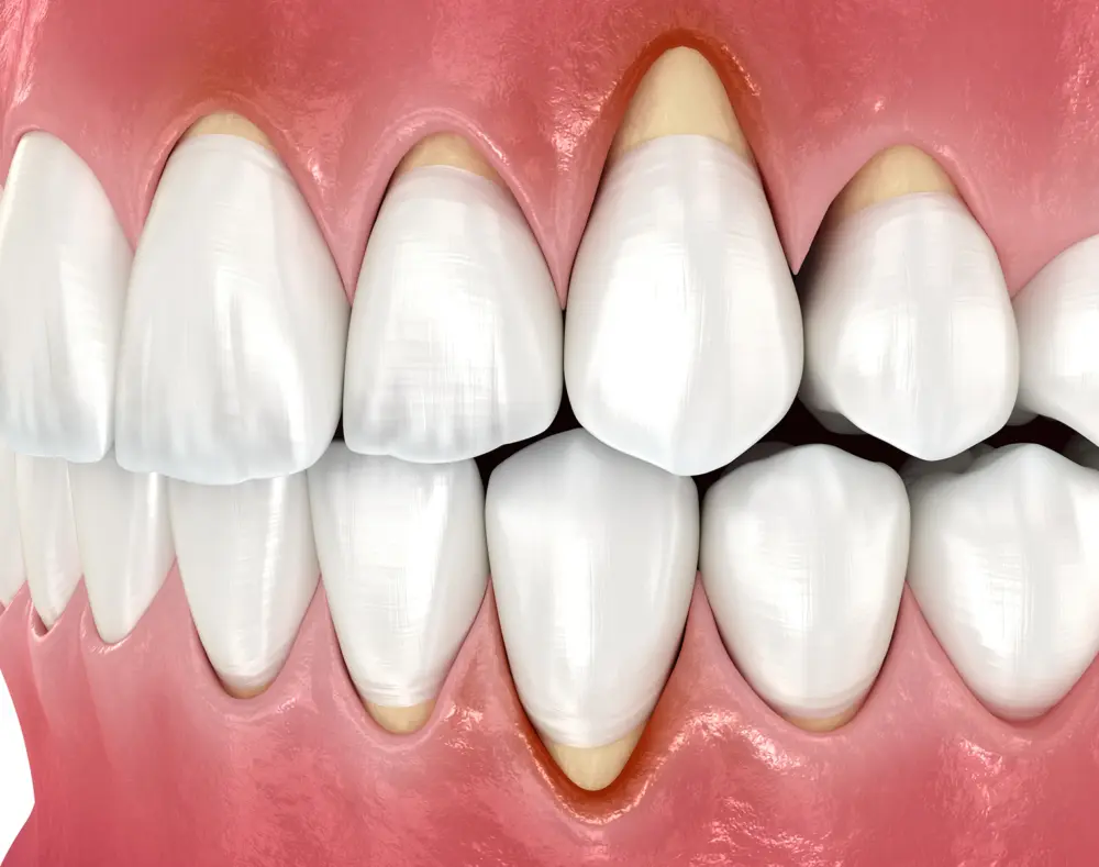 Close-up of a set of clean, white teeth with pink gums, showing the upper and lower front teeth in a slightly open mouth.