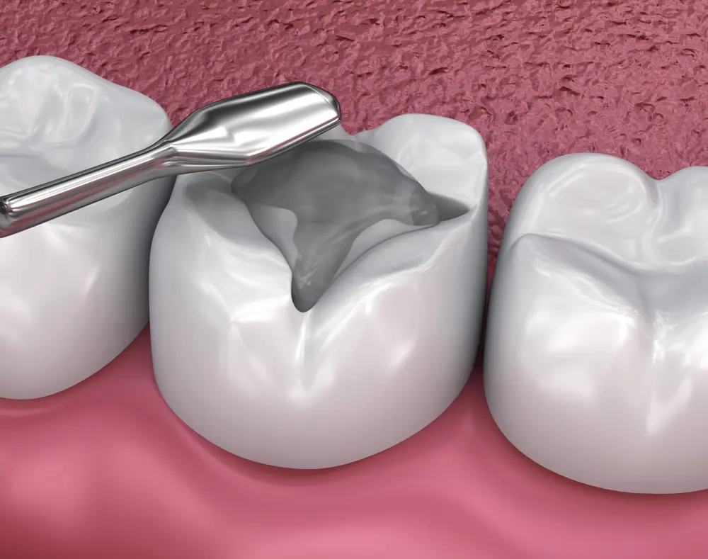 Types of Modern Filling Replacements