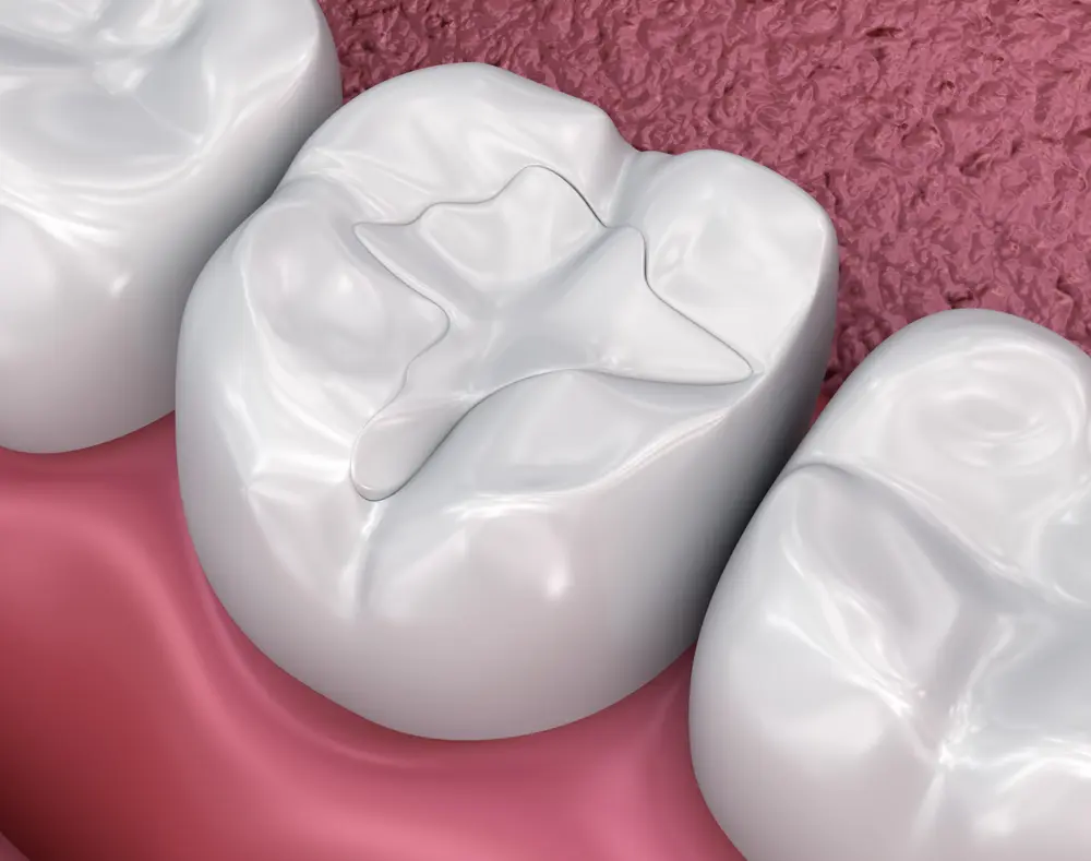 Why Fillings Need Replacing