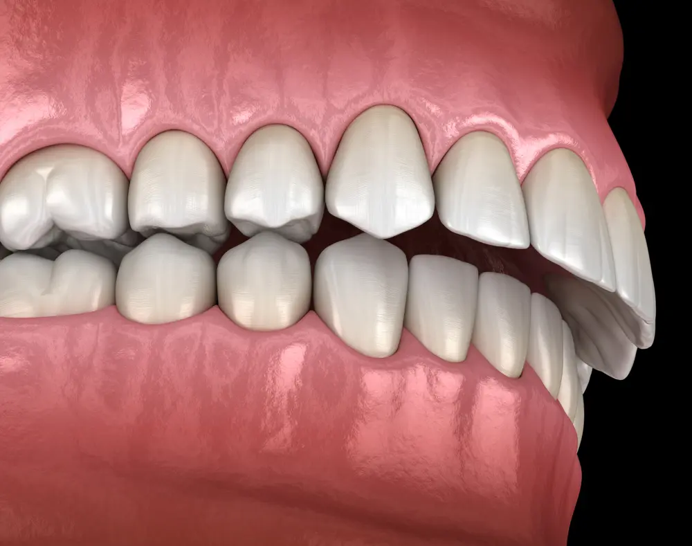 Close-up of human teeth and gums showing a side view with upper and lower teeth, and pink gums against a black background.