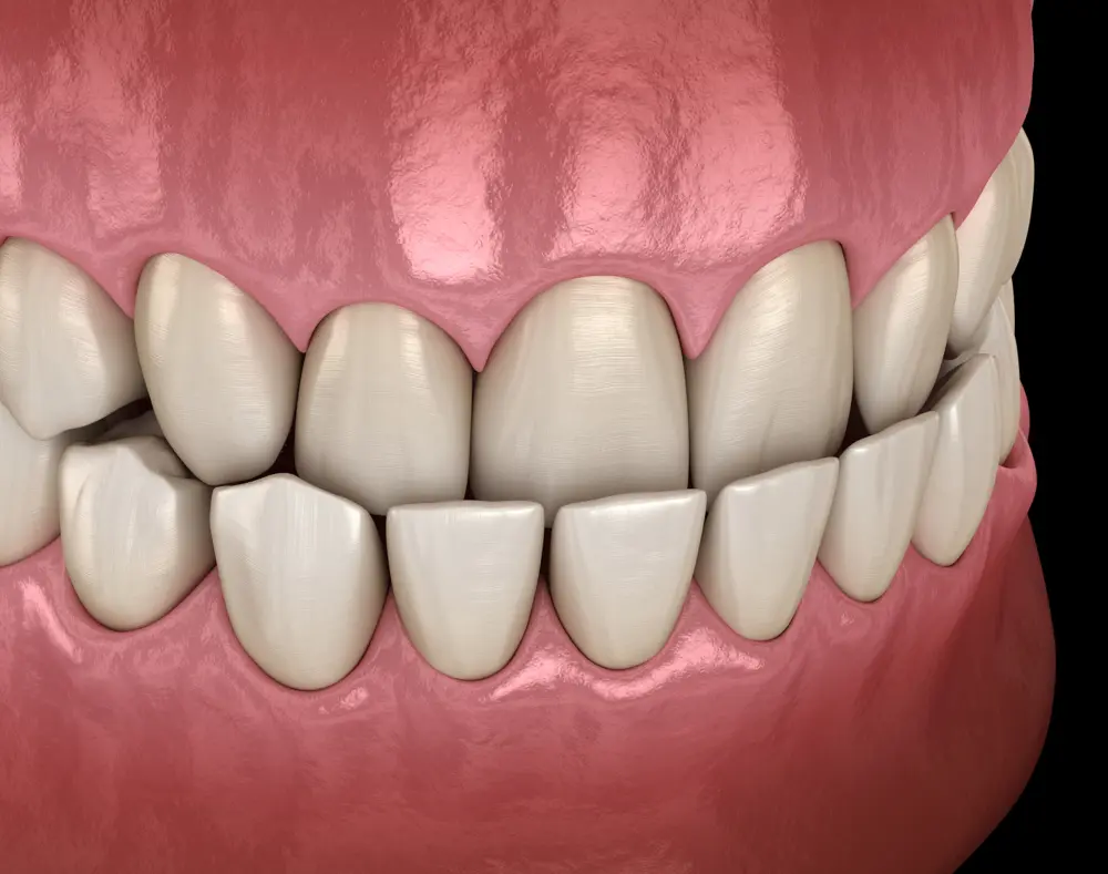 Overbite (Deep Bite)