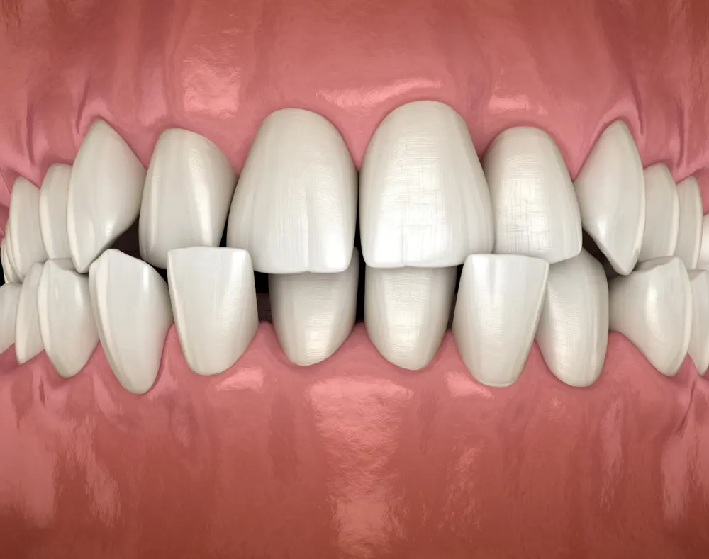 Underbite & Crossbite