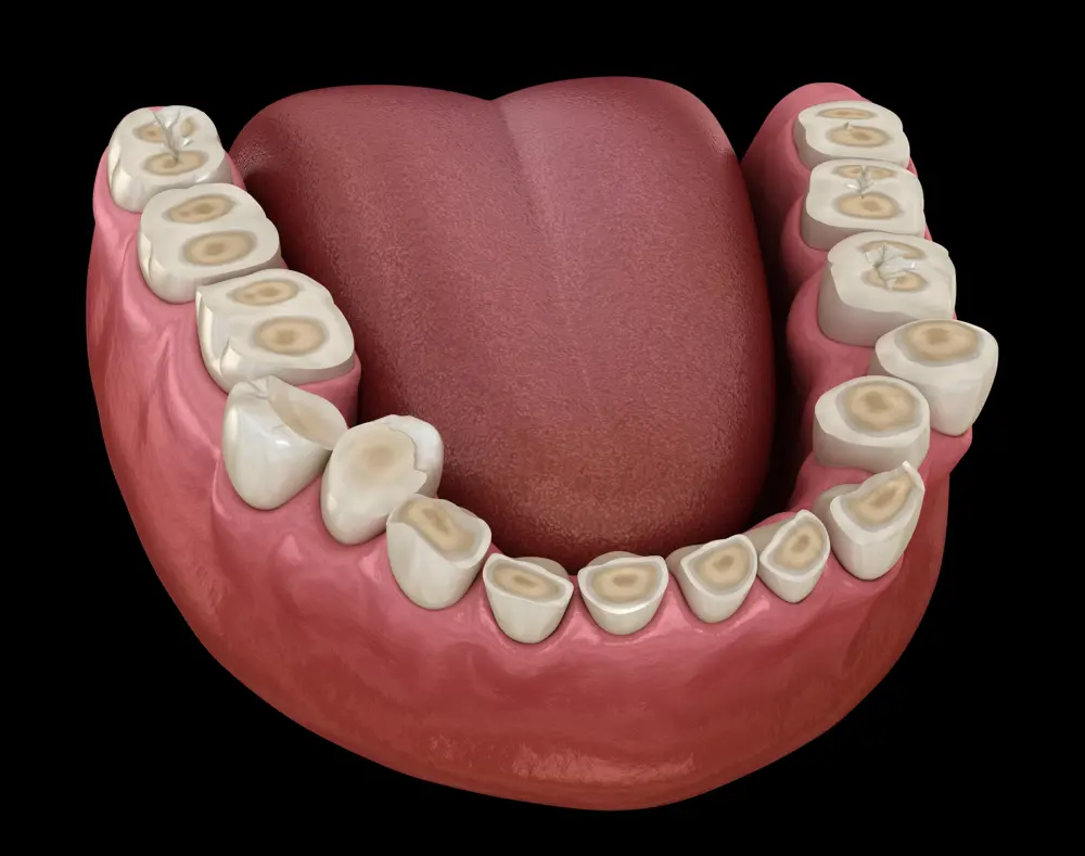 What Causes Teeth to Become Ground Down?