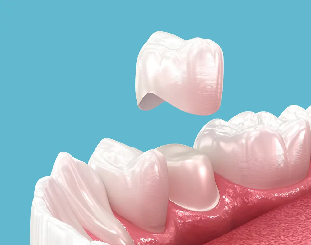 A close-up digital illustration of a dental crown about to be placed on a patient's prepared tooth, with other teeth and gums visible against a blue background.