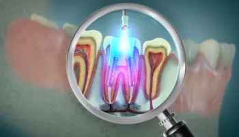 Root canal 3d