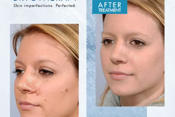 Beforeandafter cryotherapy6