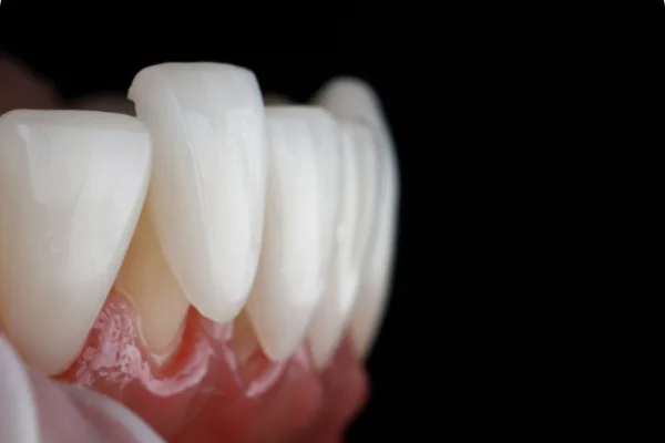 Close-up of upper front teeth with healthy gums against a black background.