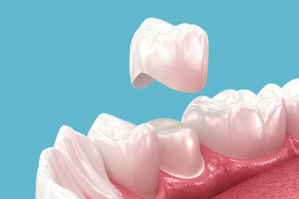 A close-up illustration of a dental crown being placed onto a molar tooth inside a mouth, with visible gums and other teeth against a blue background.