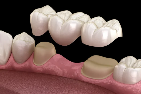 A digital illustration of teeth, showing an upper row of healthy, white molars above a pink gum line with missing and decayed teeth.