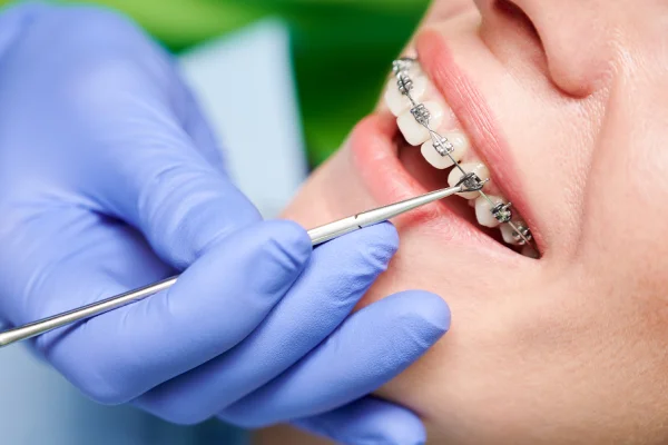 Close-up of a person with braces receiving dental adjustment from a dentist wearing blue gloves, focusing on the mouth and orthodontic devices.