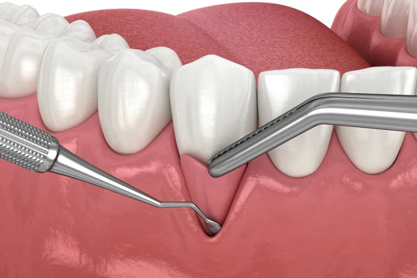 Dental tools cleaning a gingival pocket around a tooth in a detailed close-up.