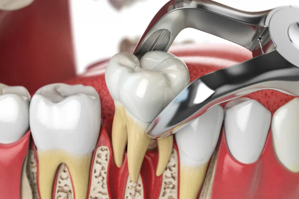 A dental instrument removes decay from a molar tooth during a dental procedure, with surrounding teeth and gums visible in the illustration.