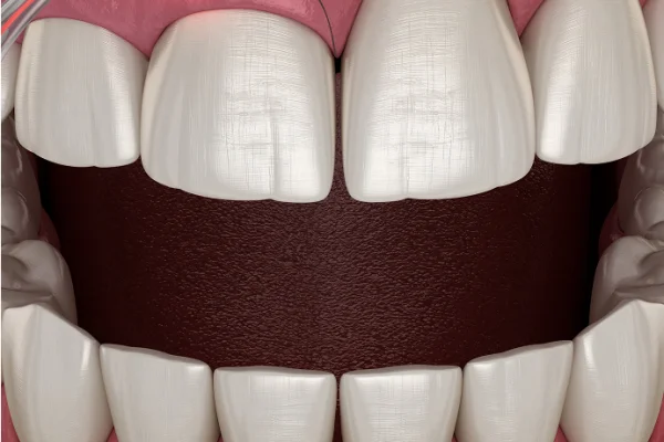 Close-up of an open mouth showing upper and lower teeth, with a dental scaler near the upper front teeth.