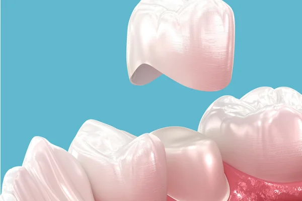 A digital illustration of teeth, including a crown and dental veneers, with a close-up view of the gums and surrounding oral structures against a blue background.