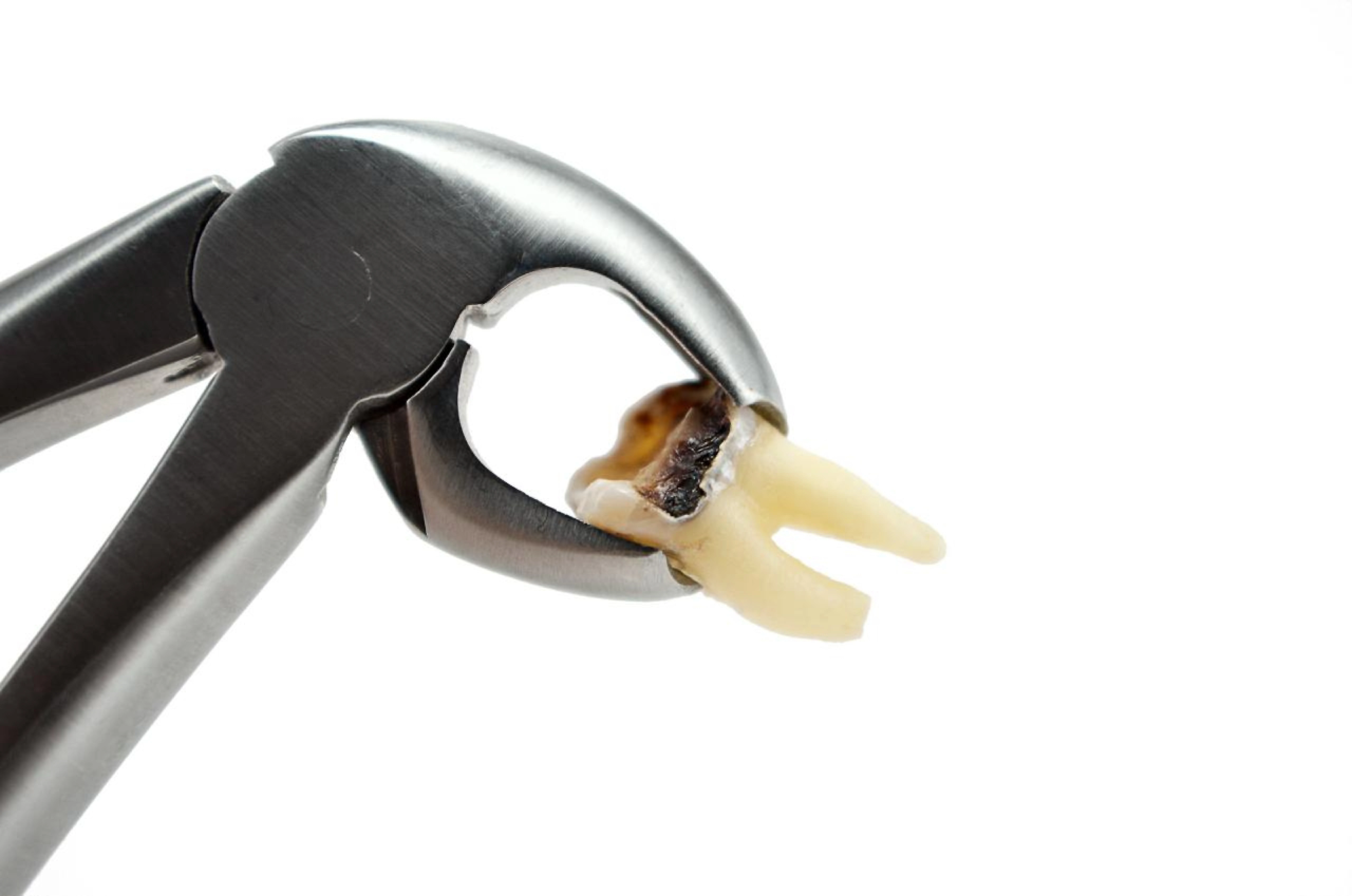Things to Do and Avoid After a Tooth Extraction