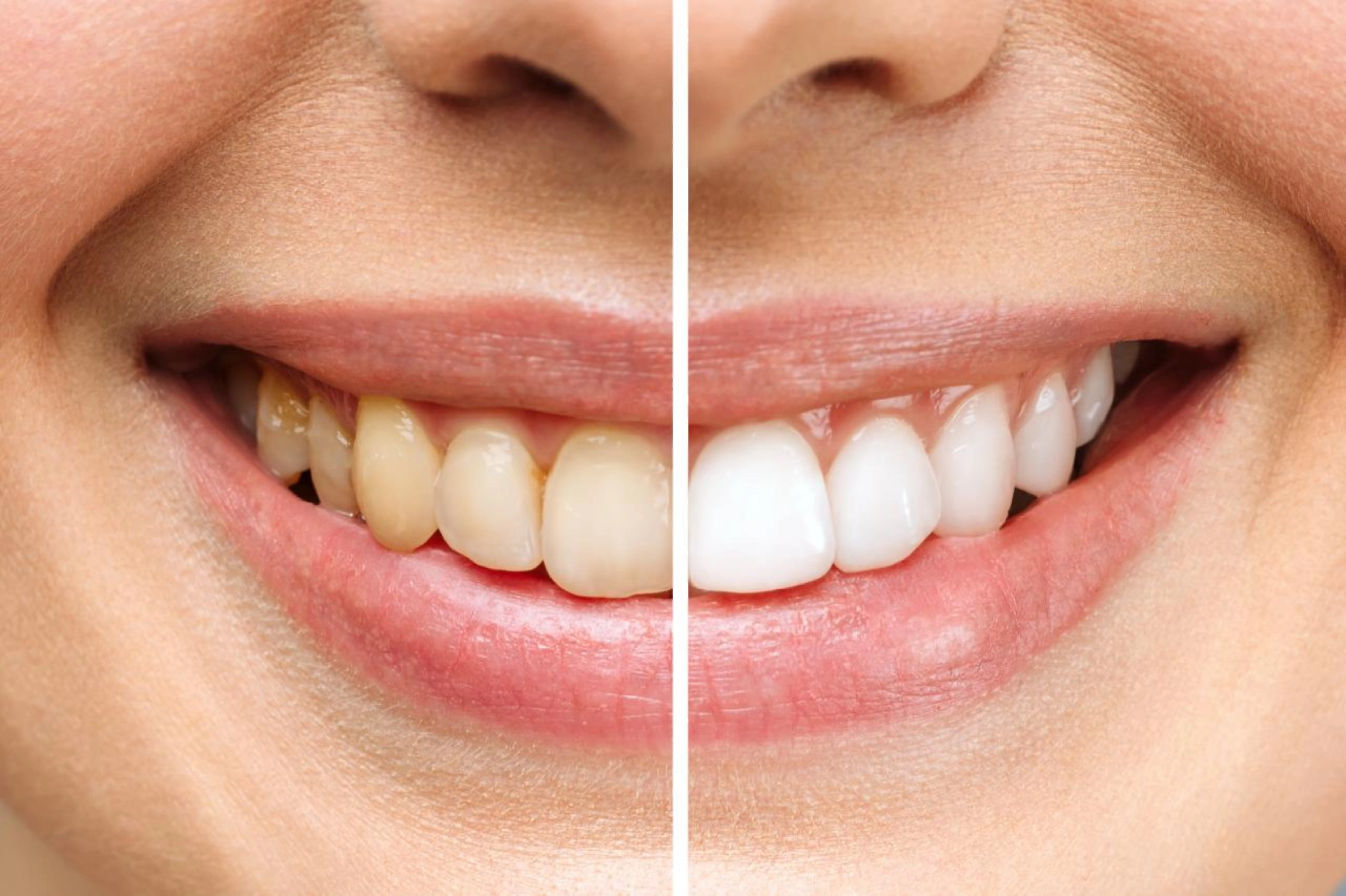 What Stains Your Teeth?