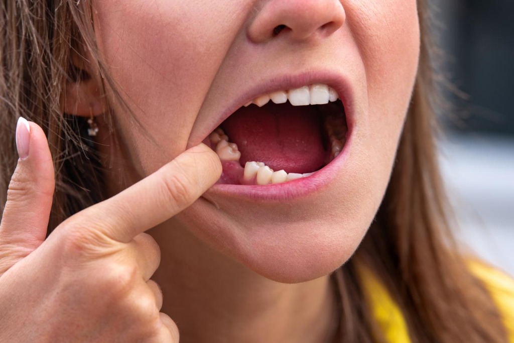 What Happens If You Don't Replace a Missing Tooth?