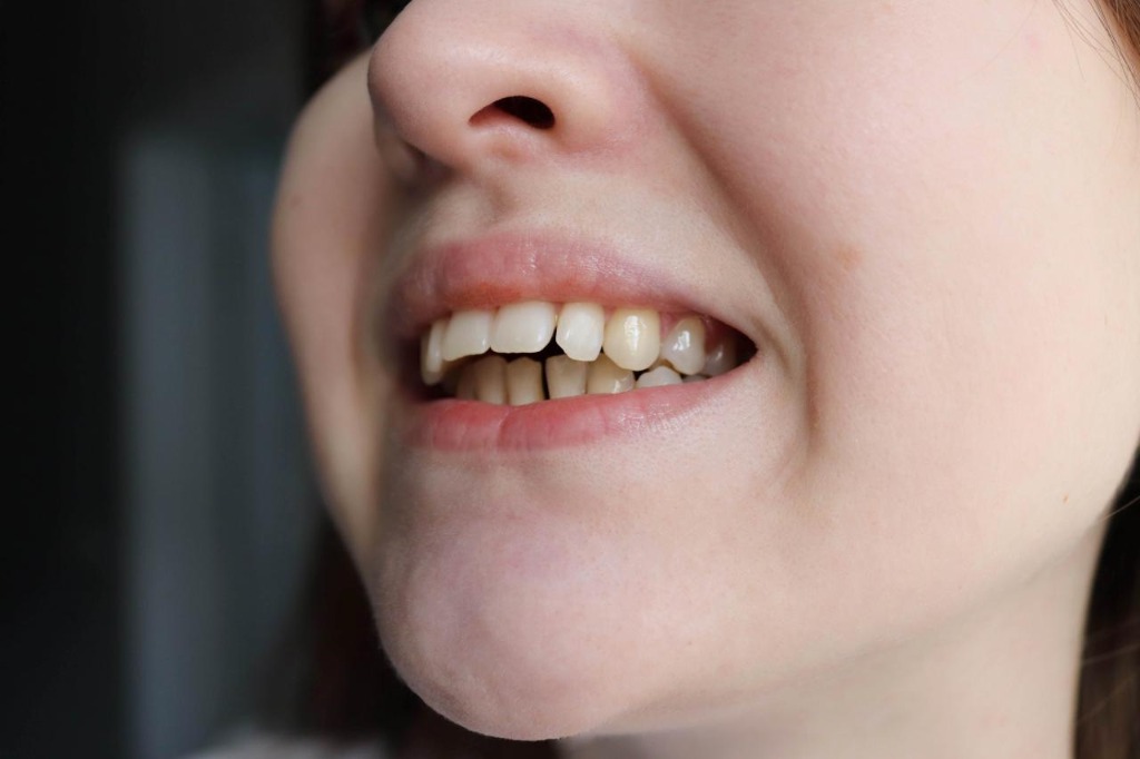 Understanding Bite Issues (Malocclusions)